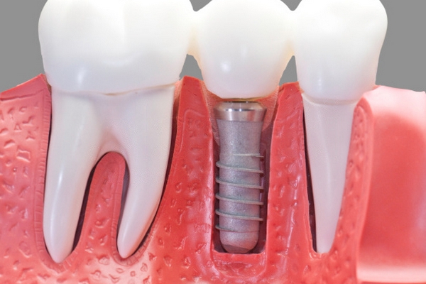 Особливості імплантації зубів: все, що потрібно знати про процедуру